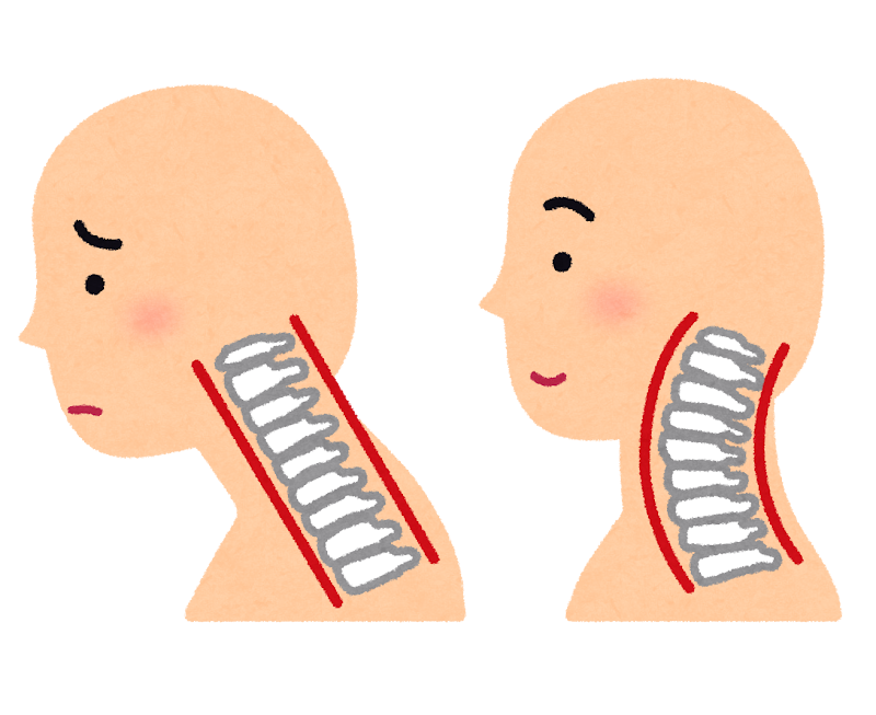 ストレートネックの姿勢の悪さを示すイラスト